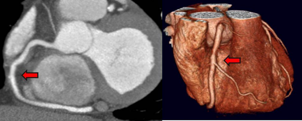 CT Coronary Angiography - London Cardiovascular Clinic