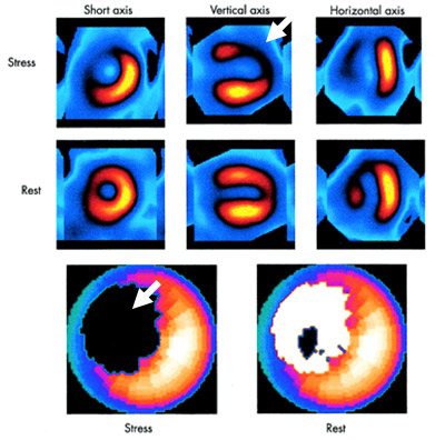 n example of perfusion scan