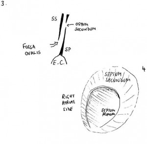 Diagram of the PFO flap in cross-section and from the right side