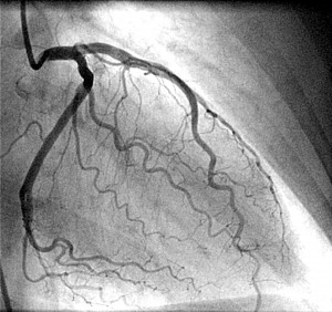 angiography