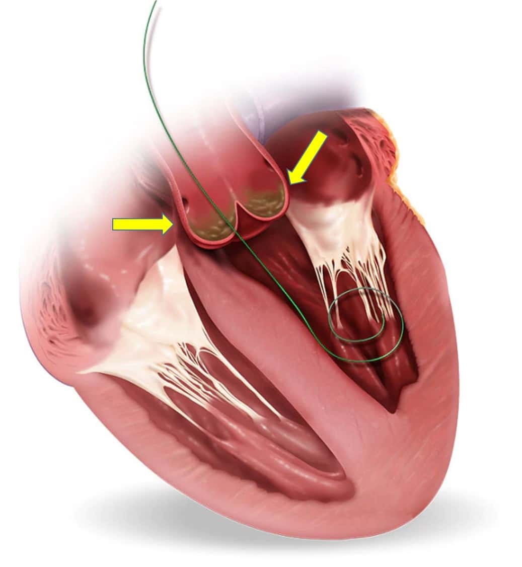 Private Tavi Surgery Transcatheter Aortic Valve Implant Lcc