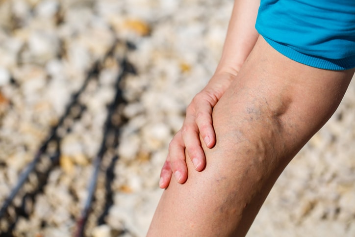 What Causes Varicose Veins? | Varicose Veins Treatment | LCC