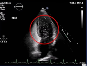 Before a PFO