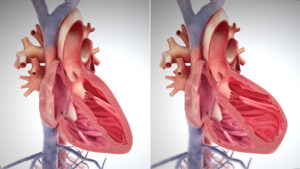 a 3d illustrations of right-sided heart failure